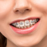 figsdental beautiful young woman with teeth braces 1024x683 1