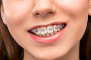 braces singapore 1 braces singapore