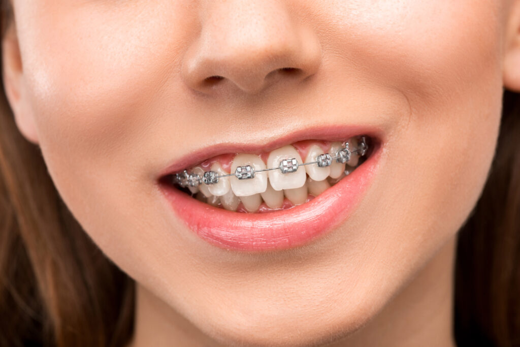 figsdental beautiful young woman with teeth braces 1024x683 1