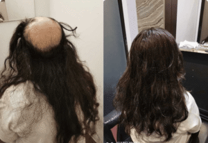 Hair Replacement SG 1 Hair Replacement SG