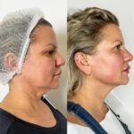 Best Aesthetic Clinic in dubai for Endolift Facial Firmness
