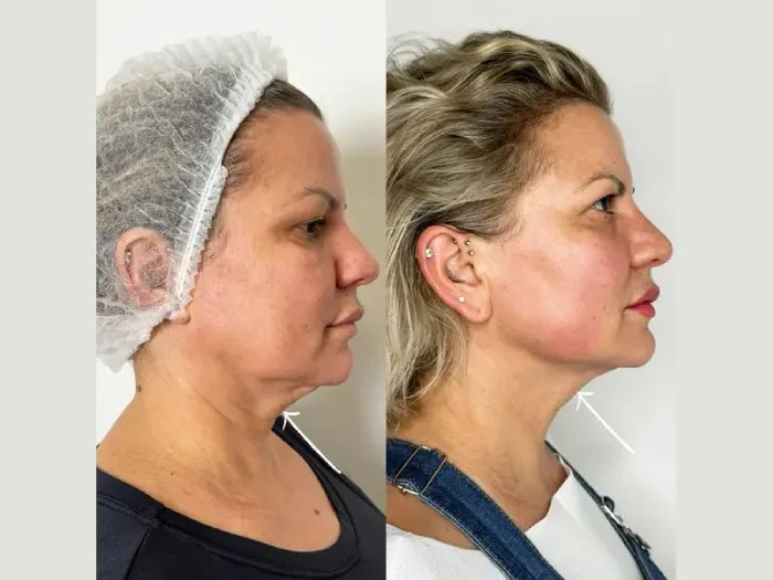 H5 Endolift