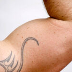 Tattoo Removal in Dubai: What Determines Your Treatment Plan