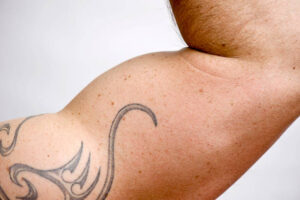 Tattoo Removal in Dubai: What Determines Your Treatment Plan 1 Tattoo Removal in Dubai: What Determines Your Treatment Plan