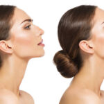 Rhinoplasty Understanding: Swelling, Scarring, and Healing Timelines