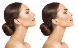 Rhinoplasty Understanding: Swelling, Scarring, and Healing Timelines