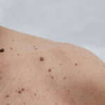 Mole Removal in Riyadh 33