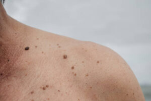 Mole Removal Aftercare: Tips for Faster Healing 1 Mole Removal Aftercare: Tips for Faster Healing