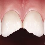 missing damaged teeth hinjewadi