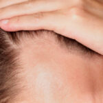 How PRP Therapy Supports Healthier Hair Follicles