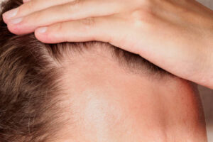 How PRP Therapy Supports Healthier Hair Follicles