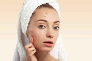 How Acne Scar Treatment Can Improve Skin Texture and Appearance 1 How Acne Scar Treatment Can Improve Skin Texture and Appearance