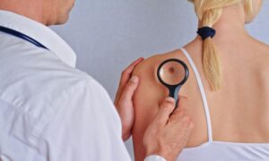 Understanding the Process of Skin Wart Removal in Riyadh 1 Understanding the Process of Skin Wart Removal in Riyadh