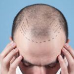 Hair Transplant in Dubai for Natural Graft Planning