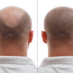 Hair Transplant in Riyadh 37