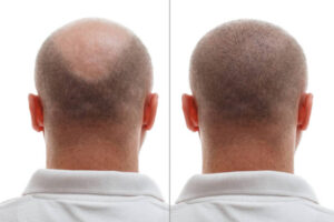 Hair Transplant FUT Method: Benefits And Limitations Explained 1 Hair Transplant FUT Method: Benefits And Limitations Explained