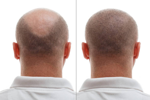 Hair Transplant in Riyadh 37