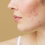 Acne Scar Treatment in Riyadh 9
