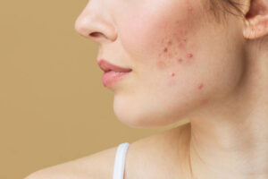 How Chemical Peels May Help With Acne Scarring and Skin Texture 1 How Chemical Peels May Help With Acne Scarring and Skin Texture
