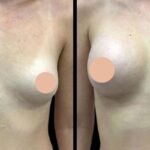 breast