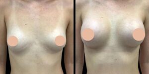 Best Breast Augmentation Surgeon in Dubai: Choosing the Right Implant Profile 1 Best Breast Augmentation Surgeon in Dubai: Choosing the Right Implant Profile