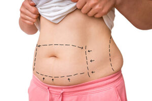Can You Exercise After Fat Melting Injections?