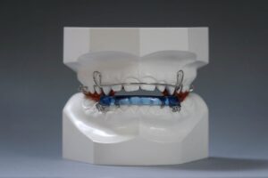 Can Dental Activators Help Correct Uneven Bites Today?