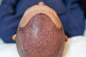 Hair Transplant in Abu Dhabi for Thin Donor Areas: Key Limits 1 Hair Transplant in Abu Dhabi for Thin Donor Areas: Key Limits