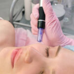 Potenza Microneedling in Riyadh 8