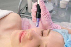 What Happens to Your Skin After Potenza Microneedling?