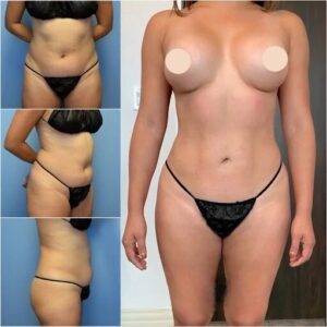 Best Doctors in Dubai for Body Contouring and Precision Fat Sculpting