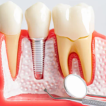 Dental Implants London Ontario A Practical Guide to Replacing Missing Teeth