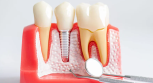 Dental Implants London Ontario: A Practical Guide to Replacing Missing Teeth 1 Dental Implants London Ontario: A Practical Guide to Replacing Missing Teeth