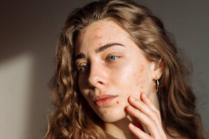 Acne Treatment vs. Home Remedies: Which Is Better?