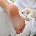 Botox for Foot Sweating in Dubai6