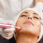DermaPen for Rosacea-Prone Skin: What You Should Know 3 DermaPen for Rosacea-Prone Skin: What You Should Know