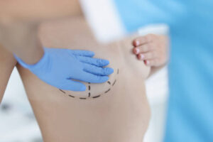 Silicone Breast Implants for Petite Frames: Proportion, Projection, and Natural Balance
