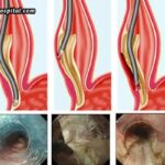 Mission Gastro Hospital: Specialized Gastroenterology Care For POEM 3 Mission Gastro Hospital: Specialized Gastroenterology Care For POEM