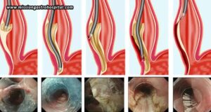 Mission Gastro Hospital: Specialized Gastroenterology Care For POEM