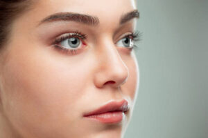 How Eyelid Surgery Addresses Droopy Upper Eyelids
