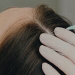 Exploring Female Hair Transplant in Dubai for Hair Restoration 3 Exploring Female Hair Transplant in Dubai for Hair Restoration