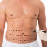 Liposuction in Riyadh for Arms and Upper Body Contouring