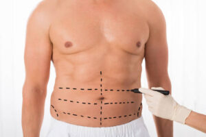 Liposuction in Riyadh for Arms and Upper Body Contouring 1 Liposuction in Riyadh for Arms and Upper Body Contouring
