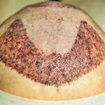 Can Hair Transplant in Sharjah Treat Genetic Hair Loss Well