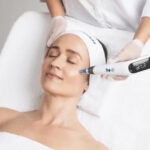 Microneedling Edmonton for Acne Scars, Fine Lines & Uneven Skin 3 Microneedling Edmonton for Acne Scars, Fine Lines & Uneven Skin