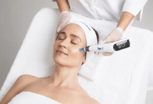 Microneedling Edmonton for Acne Scars, Fine Lines & Uneven Skin 1 Microneedling Edmonton for Acne Scars, Fine Lines & Uneven Skin