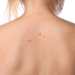 How to Treat Back Acne by Switching to Fragrance-Free Products 3 How to Treat Back Acne by Switching to Fragrance-Free Products