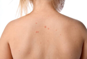How to Treat Back Acne by Switching to Fragrance-Free Products 1 How to Treat Back Acne by Switching to Fragrance-Free Products