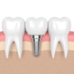 Dental Implant Cost for One Missing Tooth in Navi Mumbai: A Practical Guide