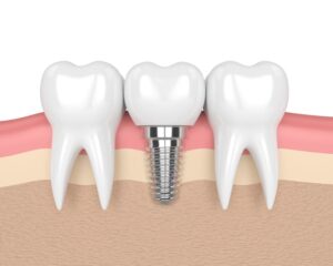 Dental Implant Cost for One Missing Tooth in Navi Mumbai: A Practical Guide 1 Dental Implant Cost for One Missing Tooth in Navi Mumbai: A Practical Guide
